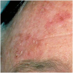 Actinic Keratosis