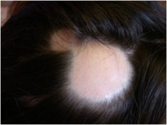 Alopecia Areata