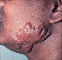 Keloid