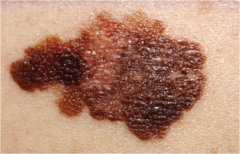 Melanoma