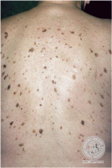 Seborrheic Keratosis