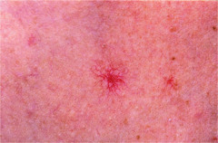 Spider Angioma