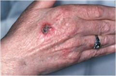 Squamous Cell Carcinoma