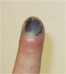 Subungual hematoma