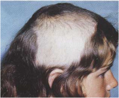 Trichotillomania