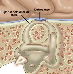 what is superior canal dehiscence associated with?