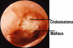 what would the test results be for cholesteatoma?