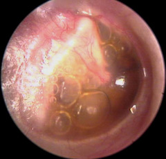 what would the test results be for otitis media?