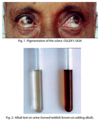 Alkaptonuria (ochronosis): findings?