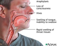 Anaphylactic shock
