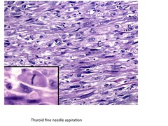 anaplastic carcinoma