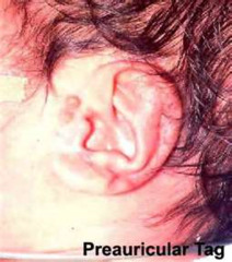 Anesthesia concern for preauricular skin tags or abnormally developed external ears