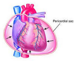 Cardiac Tamponade