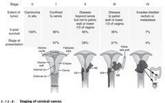 cervical cancer: staging