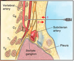 Chassiaignac's Tubercle