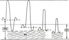 Compared with a nonobese person, what happens to functional residual capacity (FRC) in the morbidly obese patient while supine?