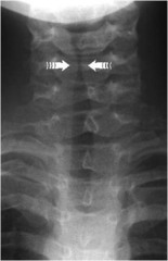 Croup aka laryngotracheobronchitis