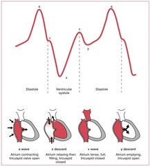 CVP waveform