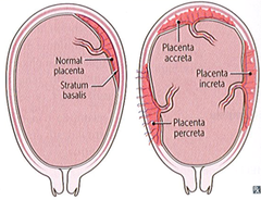 Define Placenta Accreta, Increta and Percreta  What conveys the highest risk of abnormal placentation?