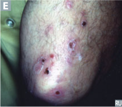 dermatitis herpetiformis