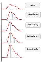 Differences between aortic and radial arterial waveforms?