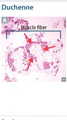 Duchenne muscular dystrophy