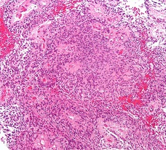 ependymal cell tumor usually in the 4th ventricle (hydrocephalus). poor prognosis perivascular pseudorosettes, rod-shaped blepharoplasts (basal ciliary bodies) near nucleus.