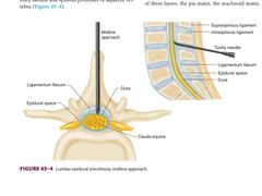 Epidural: midline approach picture