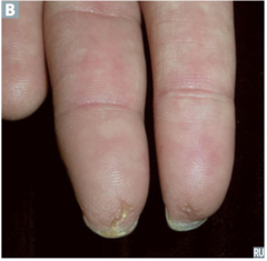 fingertip pitting, scleroderma