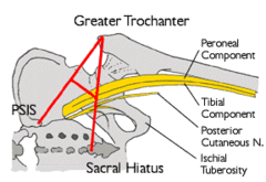 For a sciatic nerve block, what three anatomical landmarks are required?