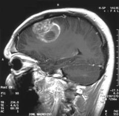 Glioblastoma multiforme: how common? survival? location? stain? histo?