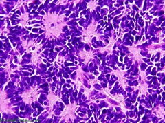 highly malignant cerebellar tumor—can compress 4th ventricle causing hydrocephalus PNET—primitive neuroectodermal tumor rosettes/pseudorosettes, solid, small blue cells, radiosensitive