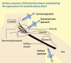 How can surgical anesthesia of the shoulder and upper extremity be obtained?