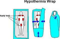 Hypothermia- Symptoms/Cause /treatment