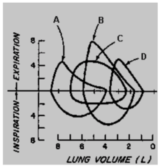 In the flow-volume loops below, chronic obstructive pulmonary disease is best represented by: a. A b. B c. C d. D