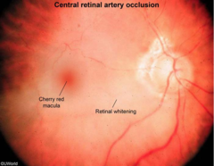 In the prone head/neck case, patient wakes up with unilateral blindness, proptosis and retinal exam shows a cherry red spot, what is the diagnosis?