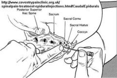 indication for caudal block