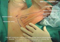 Interscalene Space/ Sheath of Brachial Plexus