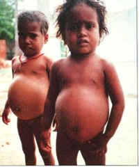 Kwashiorkor