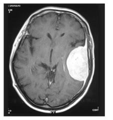 meningioma: how common? aggressive or benign? location? arises from? histo?