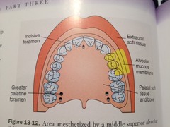 Middle Superior Alveolar Nerve Block: area anesthetized