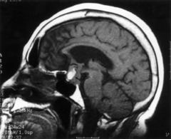 most commonly prolactinoma bitemporal hemiaopia (pressure on optic chiasm), hyper or hypopituitary sequelae from Rathke's pouch