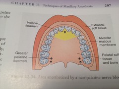 Nasopalatine Nerve Block: area anesthetized