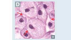 Niemann-Pick disease