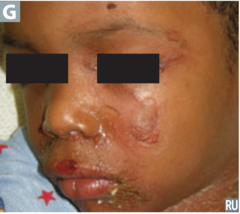 Nikolsky sign, staphylococcal scalded skin syndrome