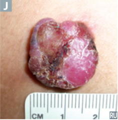 nodular melanoma