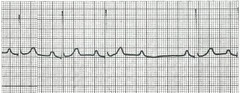 Pacemakers placement is indicated in which AV node blocks?