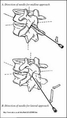 Paramedian Approach