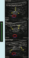 Popliteal nerve block - structures noted within popliteal fossa