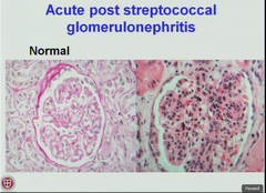 post-streptococcal glomerulonephritis